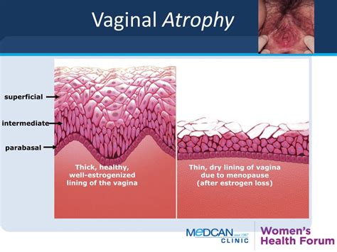 Vaginal atrophy .
